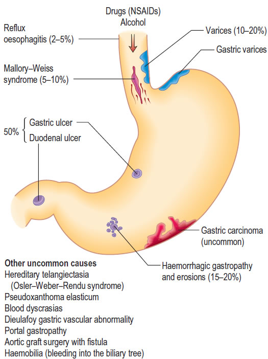 <img src="Causes of upper gastrointestinal haemorrhage. The approximate.jpg" width="525" height="702" />